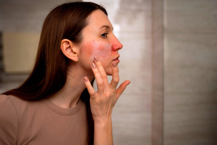 Application d'une crème sur une peau sensible