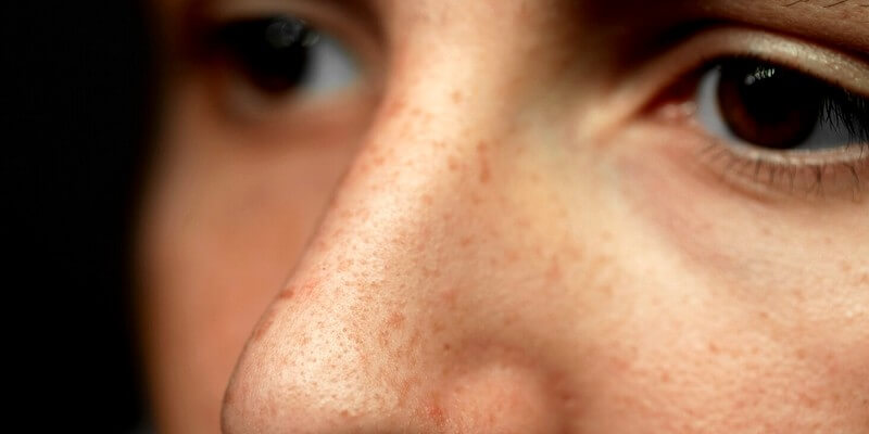 pores du nez dilatés chez une femme