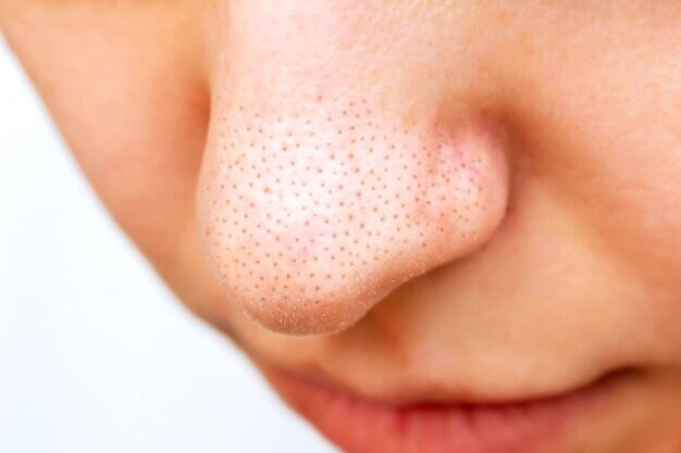 pores du nez dilatés